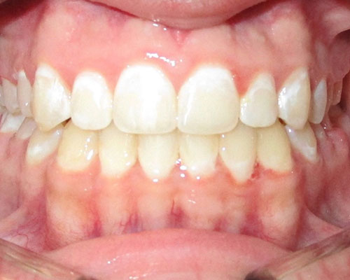 Deep bite correction