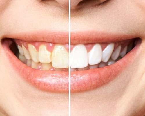 Dental fluorosis treatment