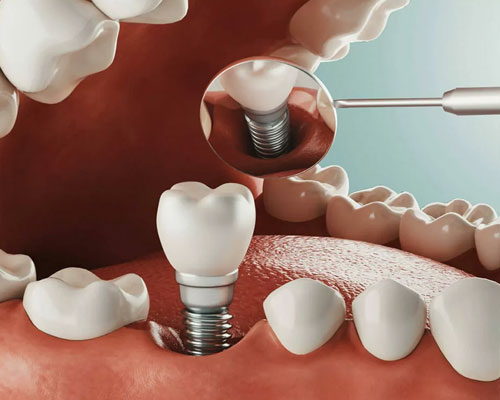 Dental implants