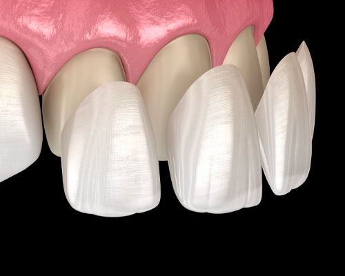 Dental laminates