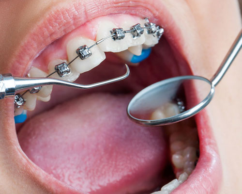Orthodontics and aligners