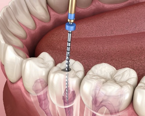 Root canal treatment