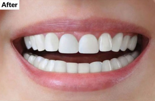 After treatment