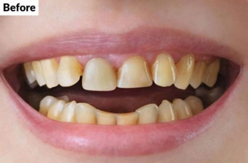 Before treatment